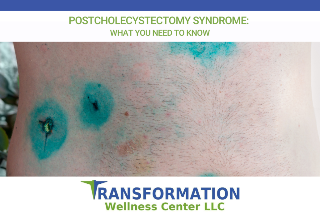 Post Colestopy Postcholecystectomy Syndrome: What You Need to Know | Transformation ...